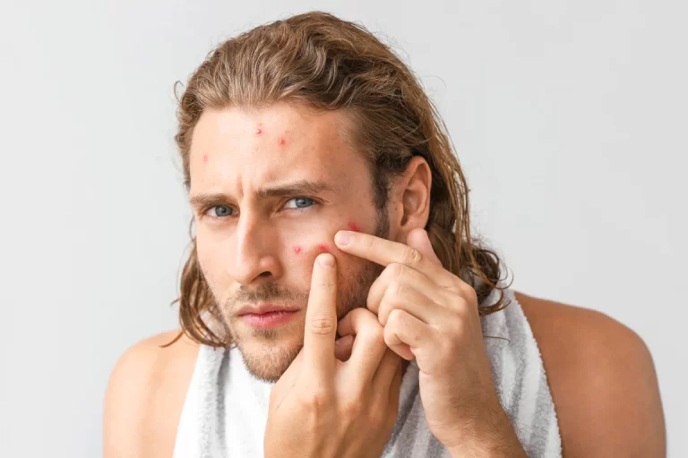 How to remove acne in men?